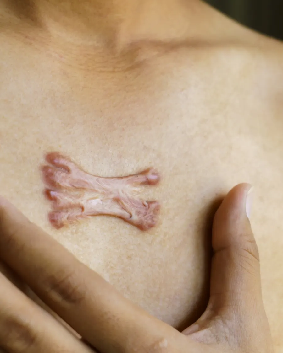 Keloids at Cinch Clinics
